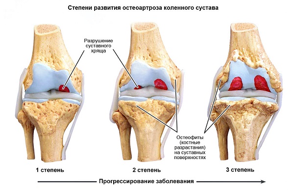 гонартроз_4.jpg